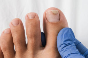Bathroom-Sink Staple WIPES OUT Nail Fungus