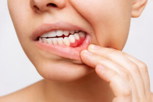 Users of This Popular Drug Are Losing Their TEETH (It’s Not What You Think)