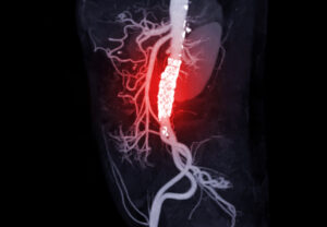 [Urgent Warning] This Antibiotic Increases Your Aneurysm Risk 56%