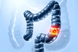 Japanese Mushroom Boosts Colon Cancer Survival 53%