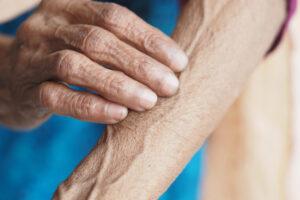 Could Your Skin Reveal Parkinson’s… Years in Advance?