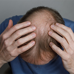SHOCKING: Weight Loss Drug’s Hidden Cost—Your HAIR!