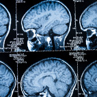 Alzheimer&rsquo;s Protocol
